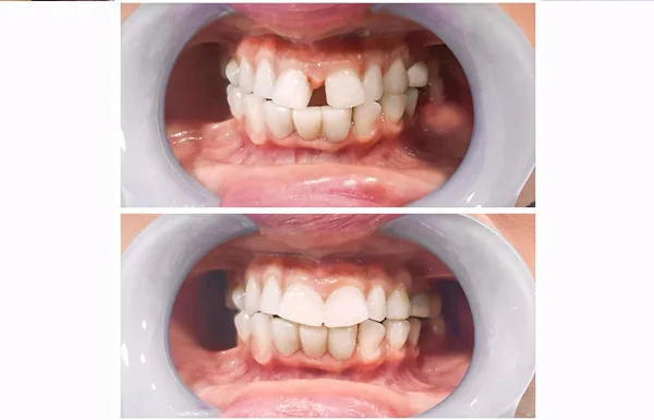 Gap Closure