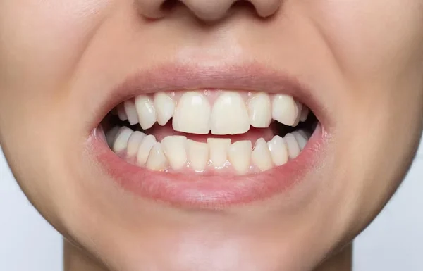 Crooked Tooth Correction