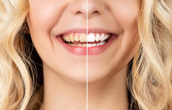 Teeth Whitening