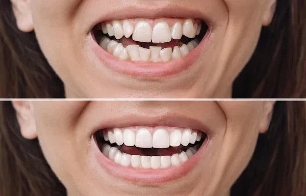 Mottling of Teeth Correction