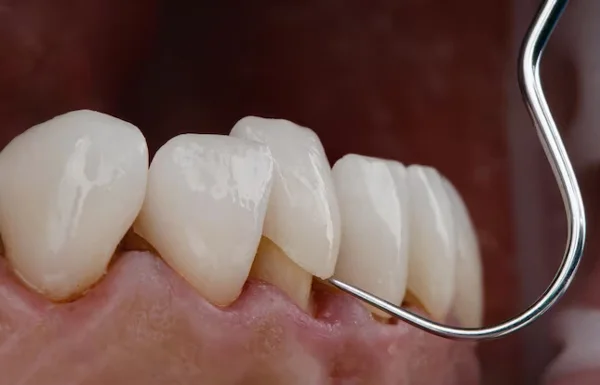 Inlays and Onlays