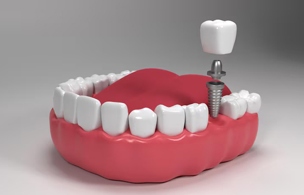 Single Tooth Implant