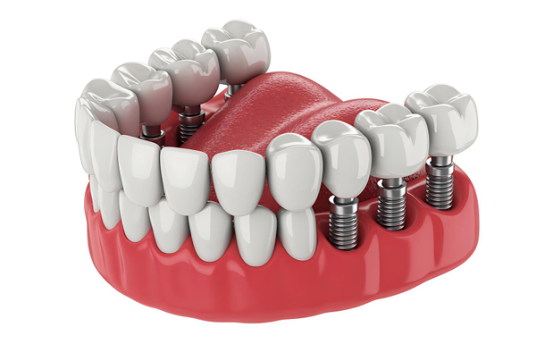 All Teeth Implants