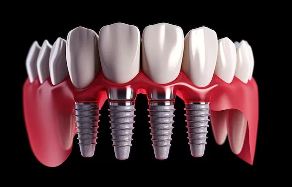 Multiple Tooth Implants
