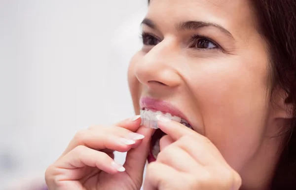Mobile Teeth Solution with Splinting