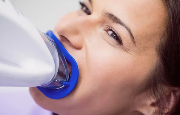 Laser Gums De Pigmentation
