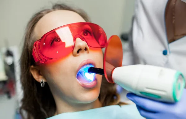 Fluoride Fillings