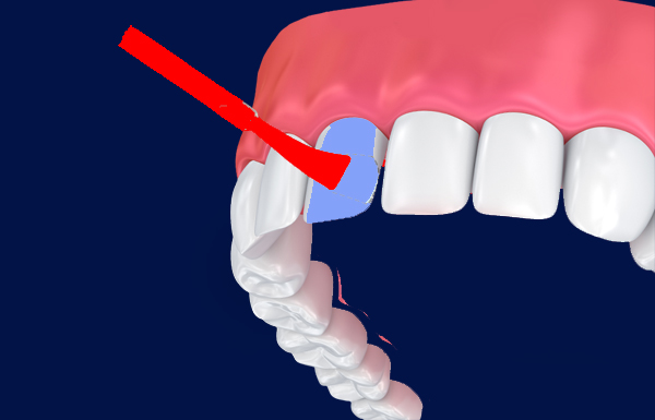 Fluoride Applications