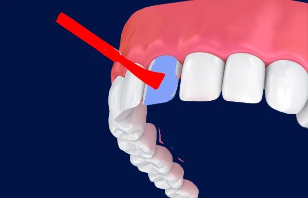 Fluoride Applications