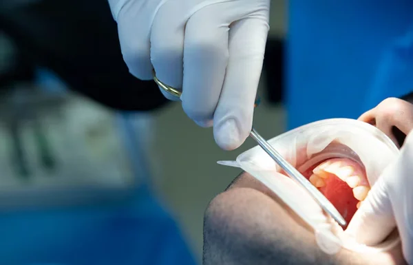 Simple and Surgical Tooth Extractions