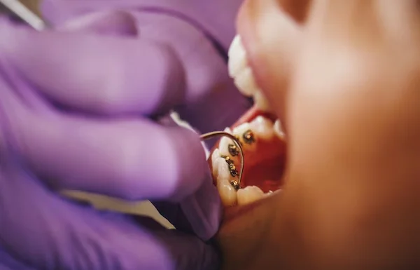 Lingual Braces