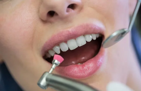 Full Mouth Scaling and Polishing